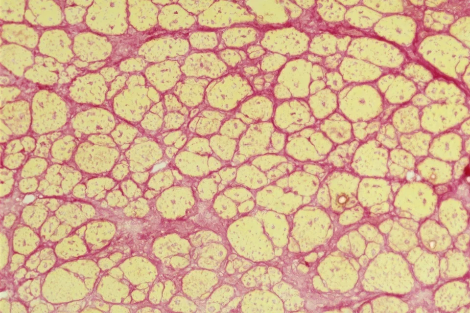 Muscular dystrophies and fibrosis